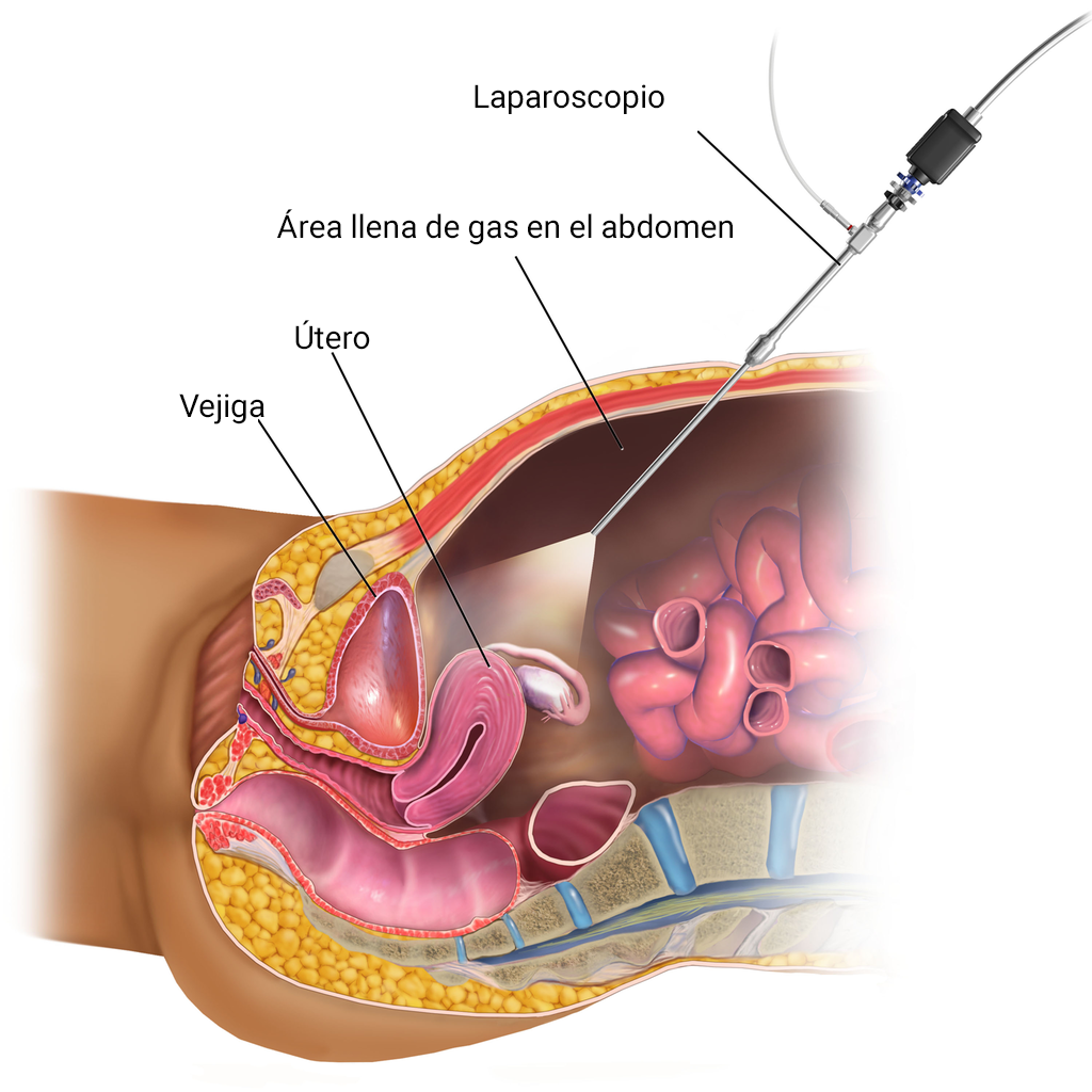 laparoscopia ginecologica